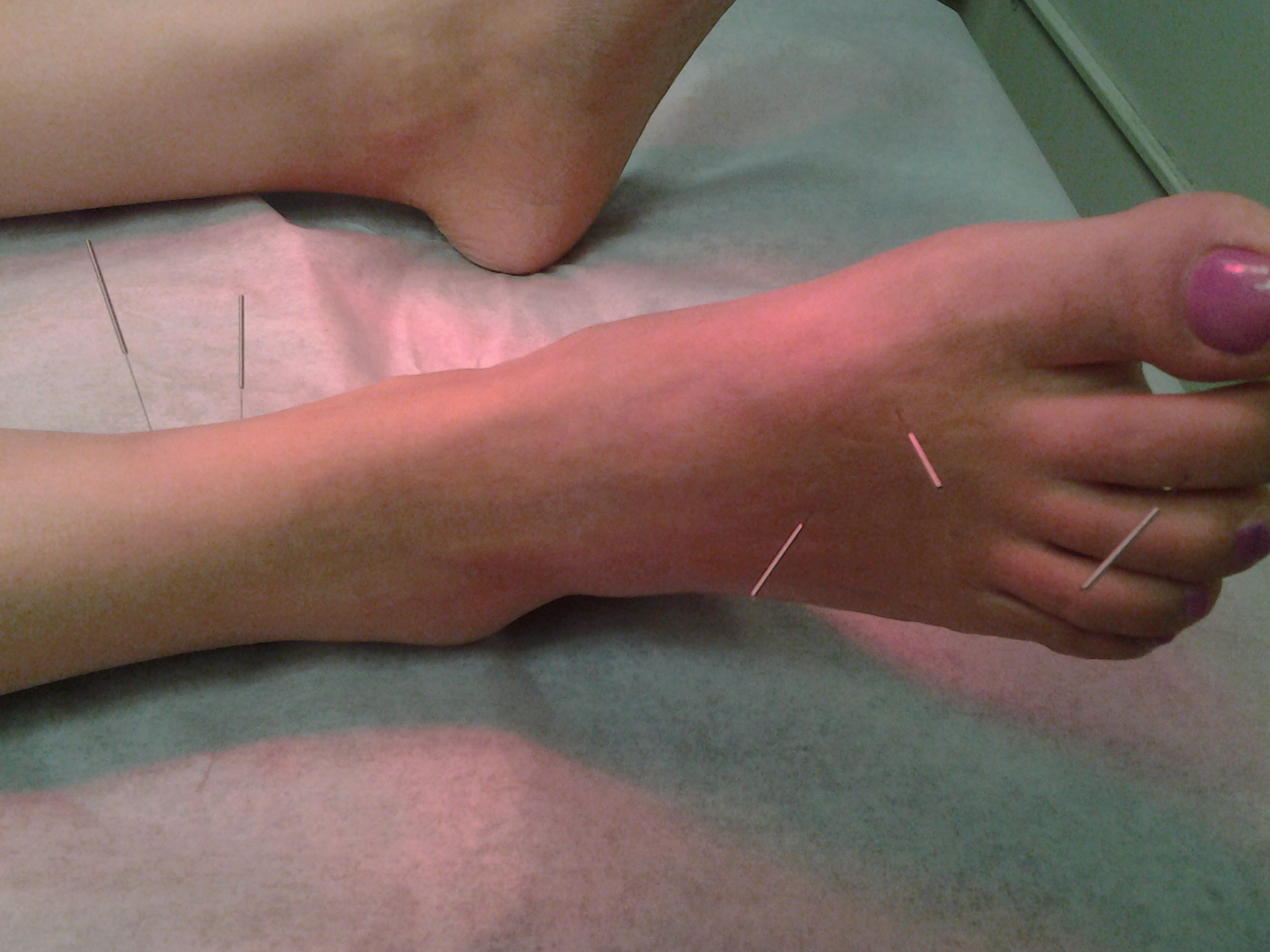 acupuncture for pain