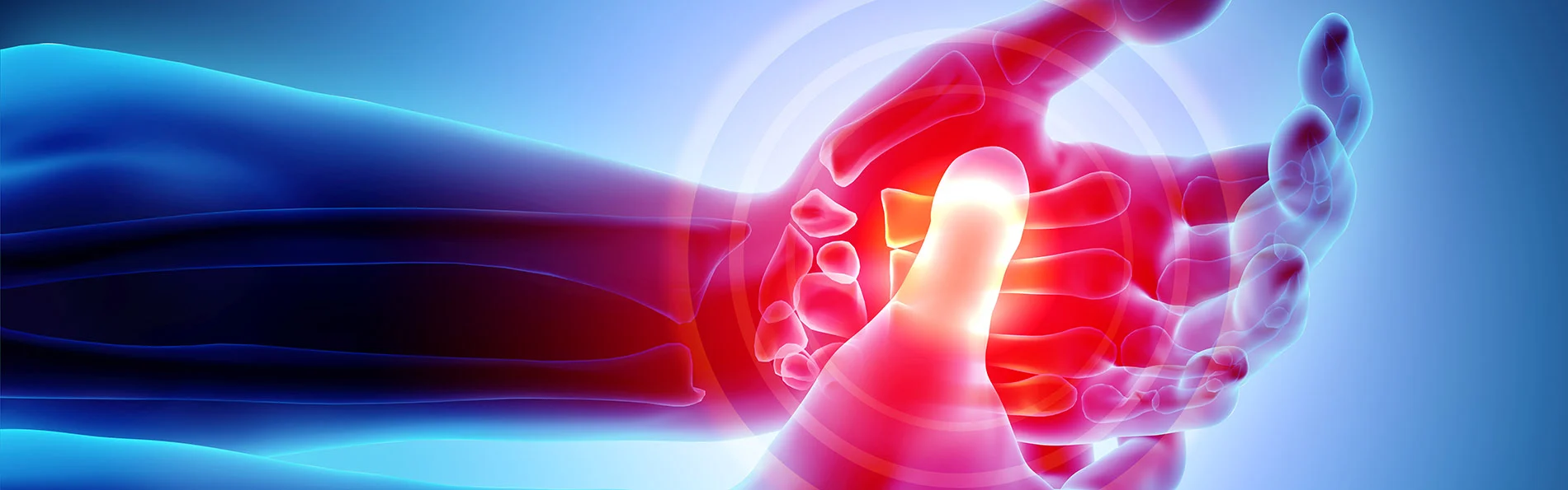 Rheumatoid Arthritis