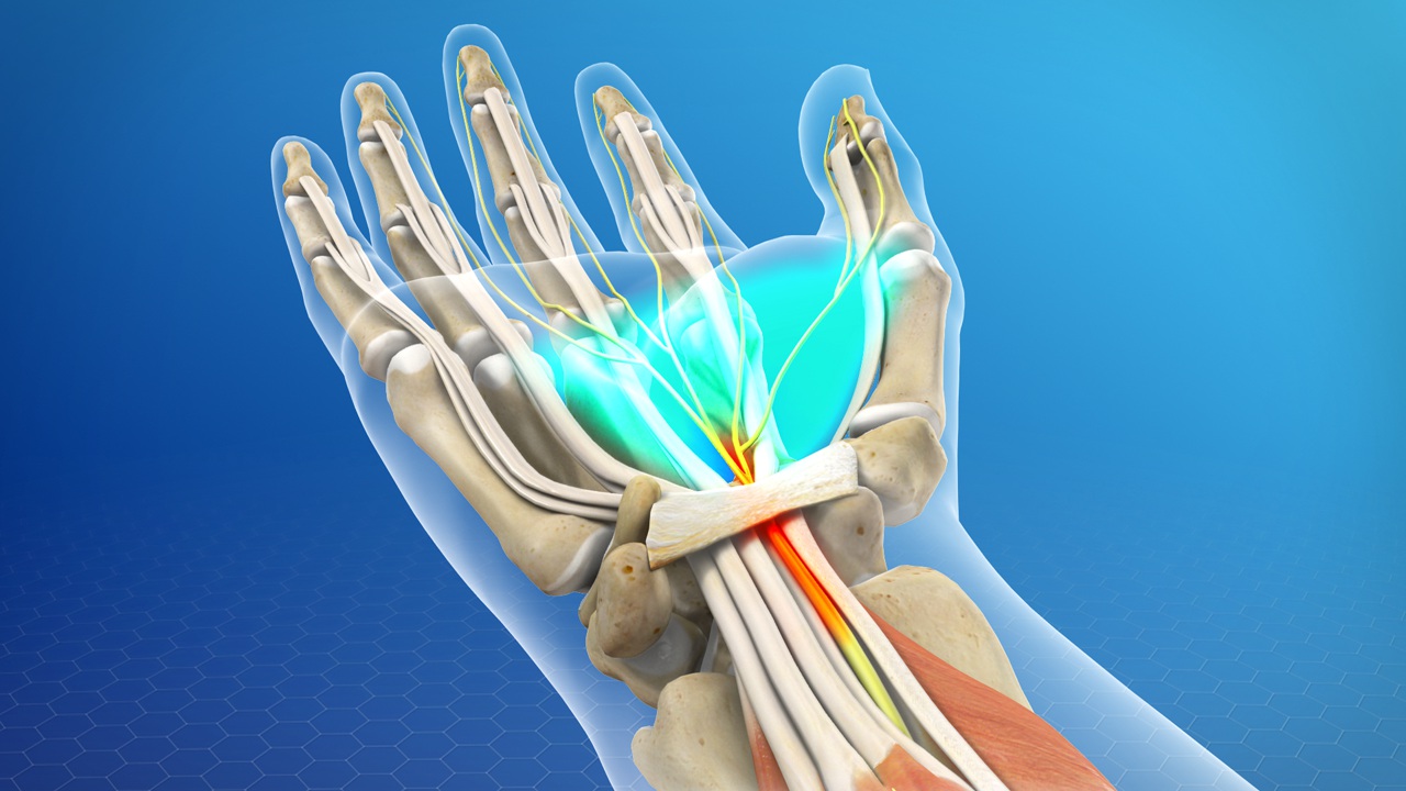 carpal tunnel syndrome