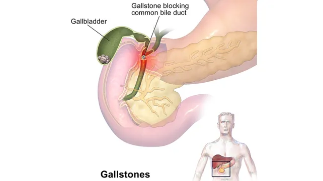 gallstones