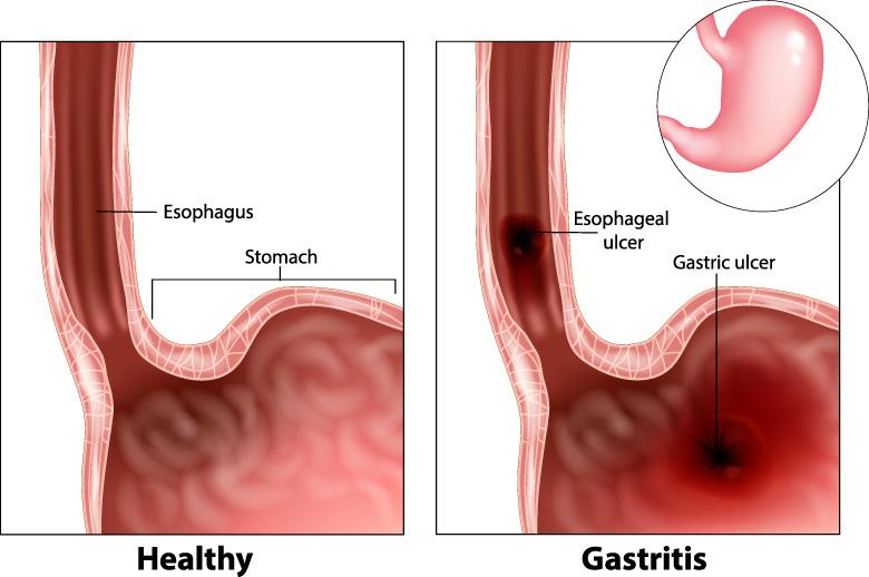 gastritis