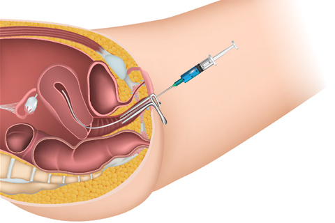 acupuncture for IUI