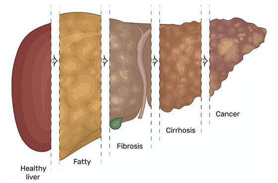 acupuncture for liver cirrhosis