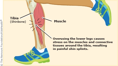 acupuncture for shin splints