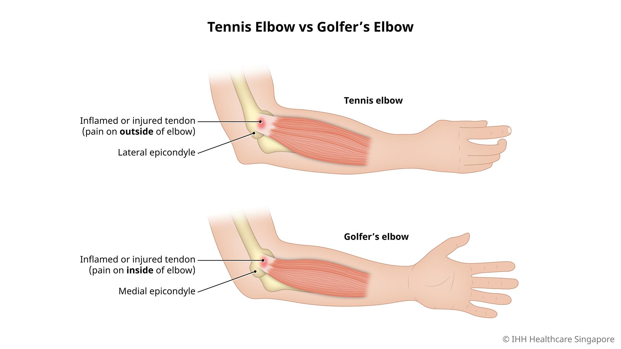 tennis elbow golfer elbow