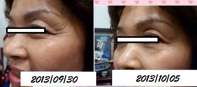 acupuncture for pain