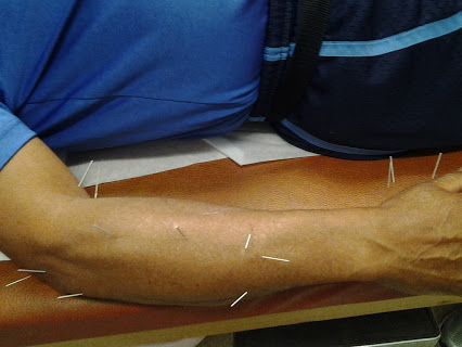 acupuncture for pain